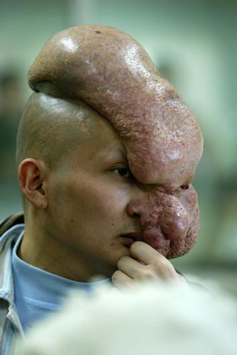 Types of facial deformaties Asian martial arts actors